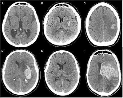 Intracranial Bleeding After Reperfusion Therapy in Acute Ischemic Stroke